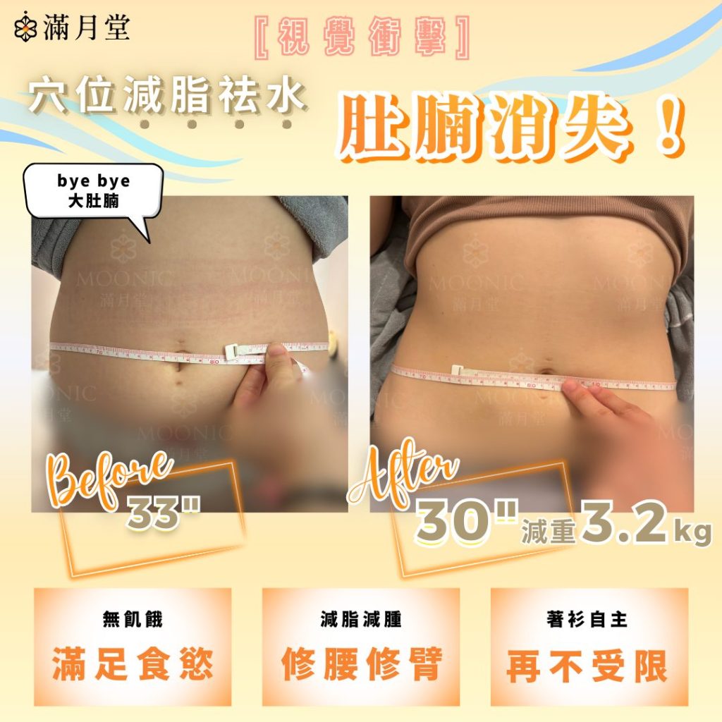 中醫減肥埋線和針灸的效果，體型明顯改善，腰圍從33吋減至30吋，減重3.2公斤，實現健康瘦身。