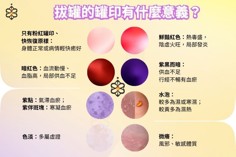 拔罐後出現的罐印顏色是什麼意思？罐印代表什麼意義？